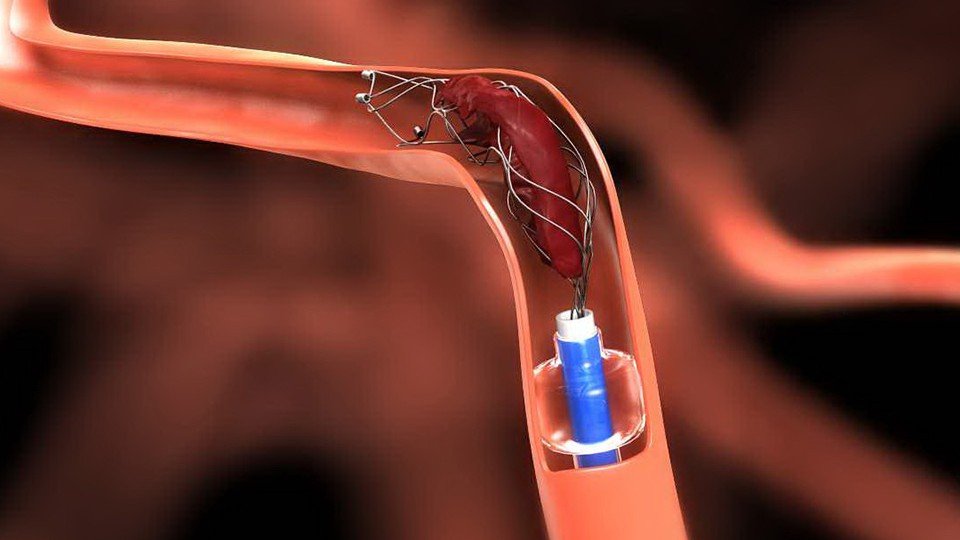 Stent Retriever