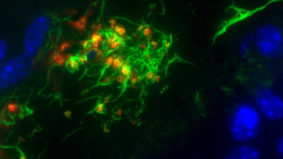 Die Abbildung aus der Publikation zeigt einen Mikrothrombus bestehend aus einem fadenförmigen Netzwerk aus VWF (grün) und Blutplättchen (rot) nach der Aktivierung des Endothels durch Tumorzellen.
