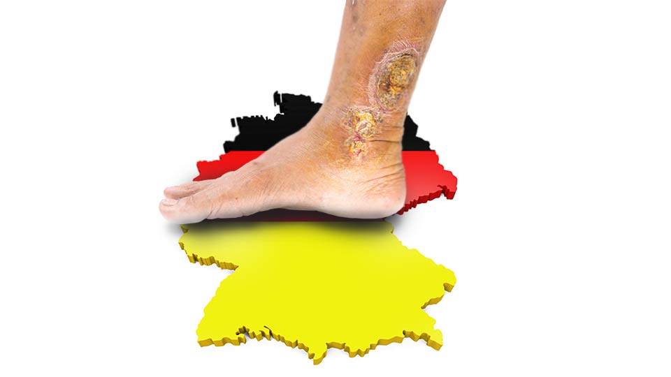 Ulcus cruris venosum in Deutschland