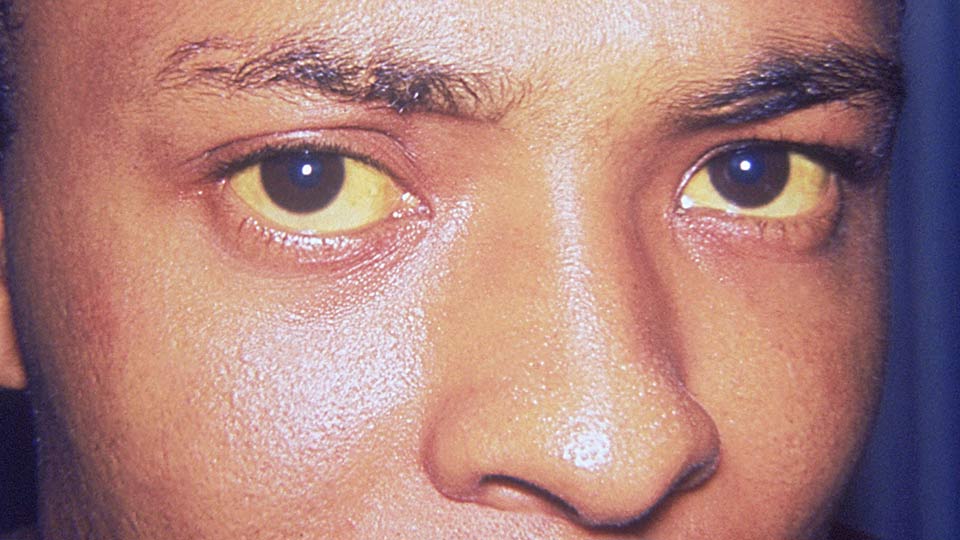 Eine durch Hepatitis verursachte Gelbsucht.
