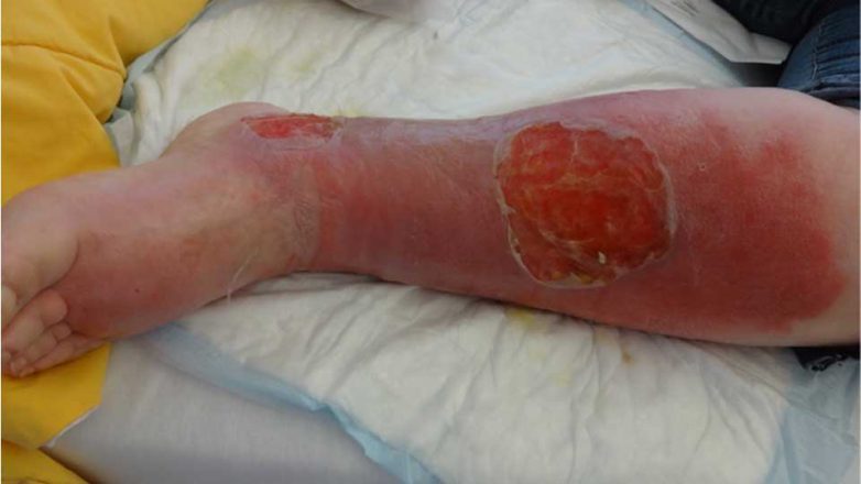 5 Facts about Chronic Wounds