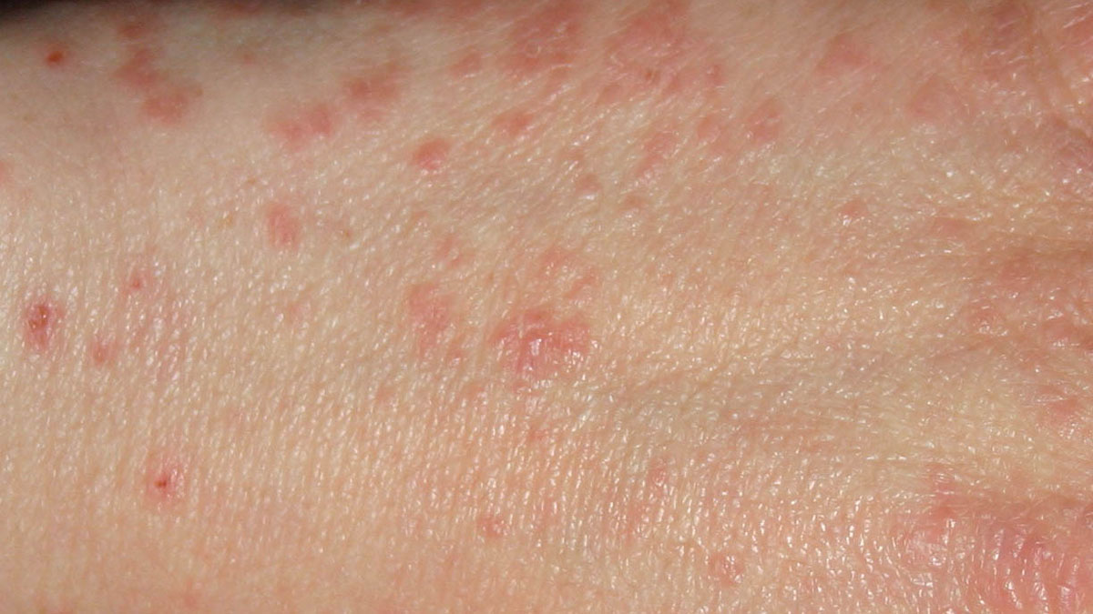 Acrodermatitis