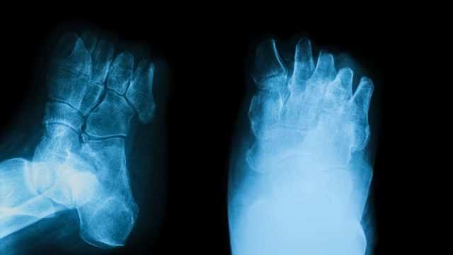 Exper­ten fordern Zweit­mei­nungs­ver­fah­ren und Anreize für Fußret­tung