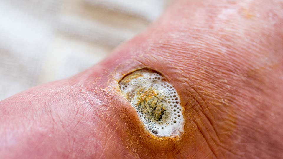 Diabetischer Fuß.