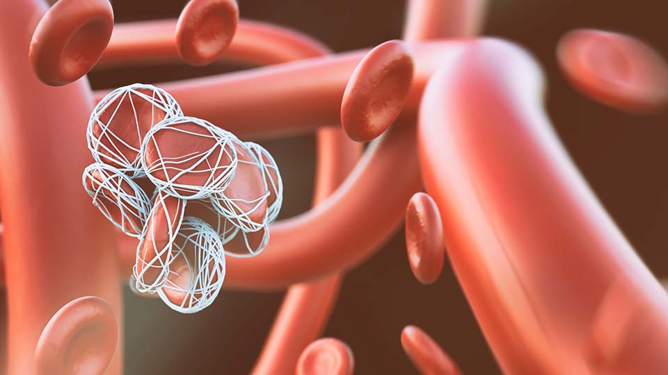 Bei einer Thrombose bildet sich ein Blutgerinnsel - ein sogenannter Thrombus - in einem Blutgefäß. 