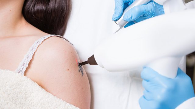 Heilkund­li­che Tätig­keit: Wieso nicht jeder Tätowie­rer Tattoos entfer­nen darf