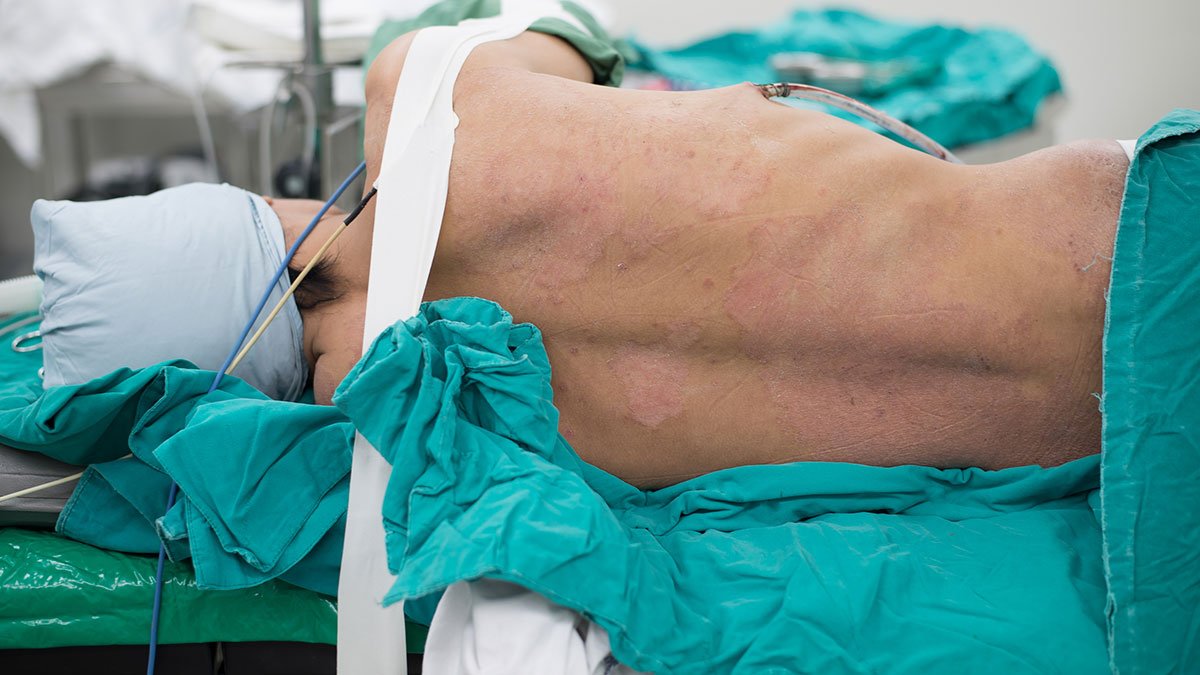 Patient nach der Lagerung auf die linke Seite (Symbolbild)