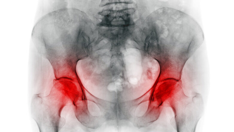 Osteo­po­rose: Skelett­er­kran­kung mit drasti­schen Folgen